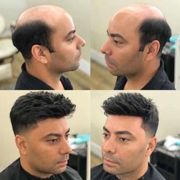 Hair Replacement Associates