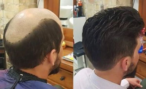 Hair Replacement Associates