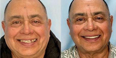 Before and after dental restoration with a big smile.