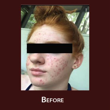 Photo of young teen with acne