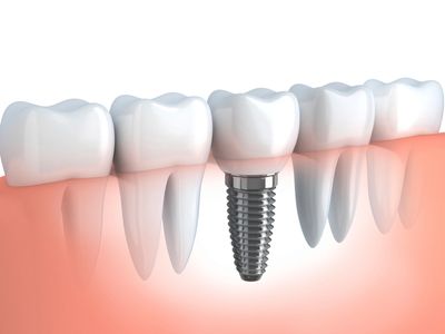 Los Angeles dentists Poria Edalat Saman Sina California Las Vegas dentist Monterey hills dental DDS
