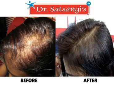 Are you losing hair, seeing signs of hair thinning, or struggling with postpartum hair loss? callNow