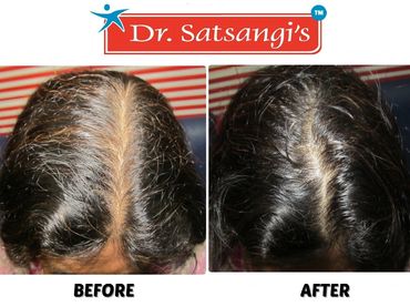 Struggling with postpartum hair loss? Whether it's female pattern baldness or male pattern-call now