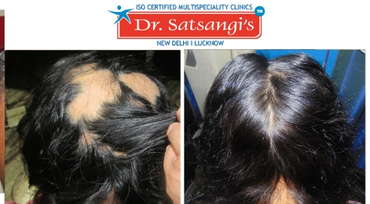 Our personalized treatments help restore scalp health, boost regrowth, and stop further hair fall.