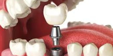 Diş implantı
