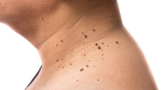 Acrocordones: Frecuentes en diabeticos y resistencia a la insulina