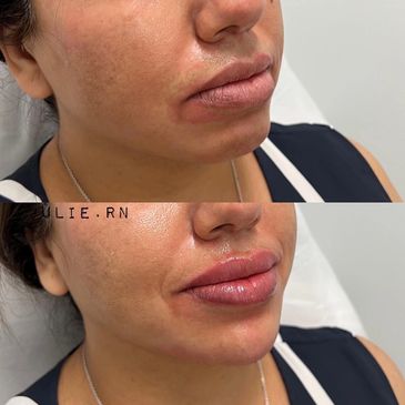 Derfmal fillers, fillers before and after, cosmetic fillers Melbourne, Lip fillers, face fillers