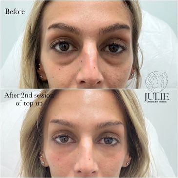Derfmal fillers, fillers before and after, cosmetic fillers Melbourne, Lip fillers, face fillers