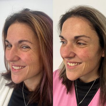 anti-wrinkle injections, anti-wrinkle injection, anti-wrinkle injection Melbourne