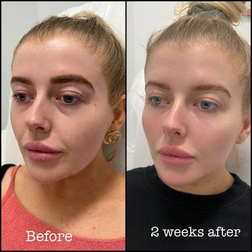 Derfmal fillers, fillers before and after, cosmetic fillers Melbourne, Lip fillers, face fillers
