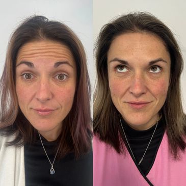 Anti-wrinkle before and after, anti-wrinkle treatment, botox melbourne, anti-wrinkle injections