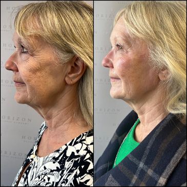 Derfmal fillers, fillers before and after, cosmetic fillers Melbourne, Lip fillers, face fillers