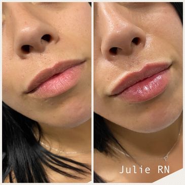 Derfmal fillers, fillers before and after, cosmetic fillers Melbourne, Lip fillers, face fillers