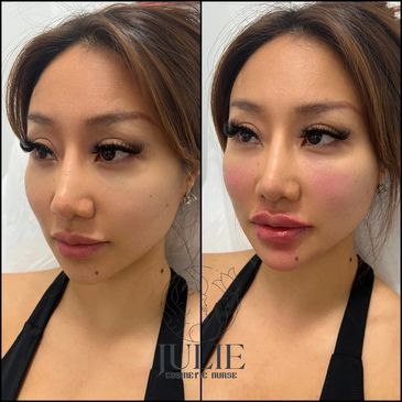 Derfmal fillers, fillers before and after, cosmetic fillers Melbourne, Lip fillers, face fillers