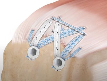 Rotator cuff repair