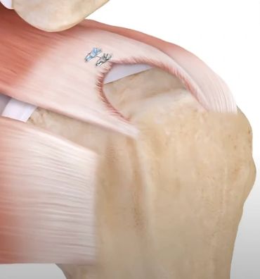 Illustration of a tendon tear