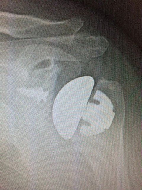Xray of an anatomic shoulder replacement