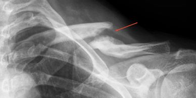 Clavicle fracture xray