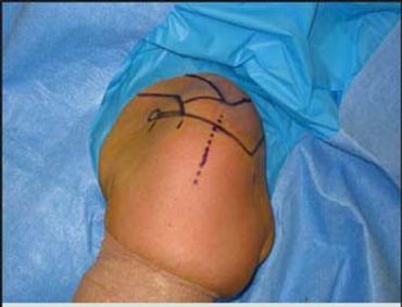 Typical scar if open surgery utilised