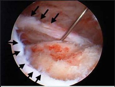 Intraoperative photo of a tendon tear