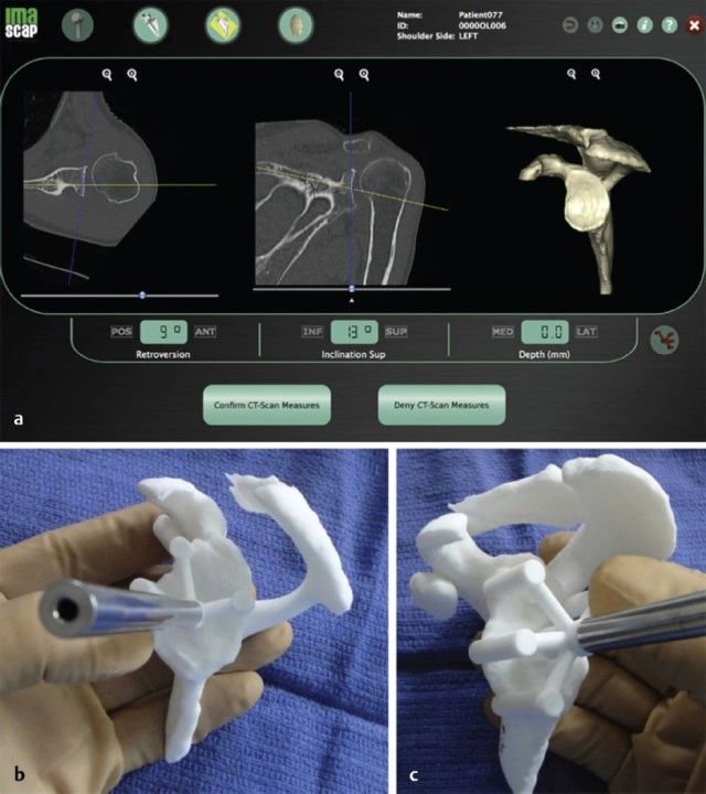 3D planning and personalised surgery jig for shoudler replacement