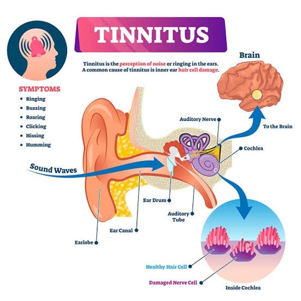 Diagram explaining tinnitus and its ear anatomy.