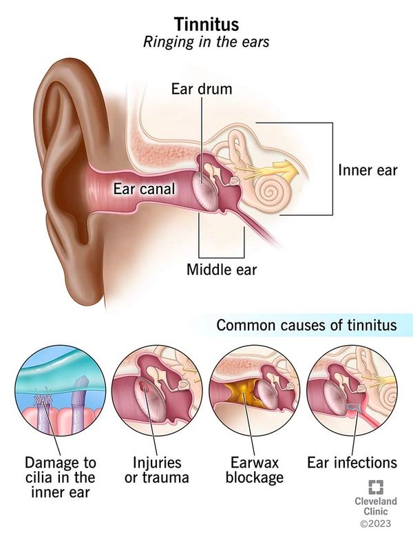 Diagram showing tinnitus causes and ear anatomy.