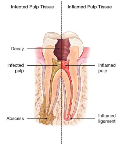 Diagram of root canal problems