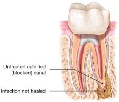 Photo of tooth needing endodontic pretreatment