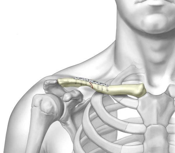Sistema TriMed fijación para Clavícula