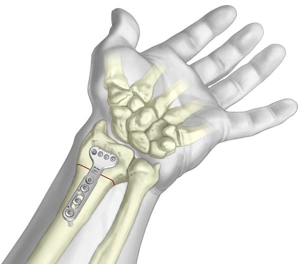 Sistema de Osteotomía Radial TriMed