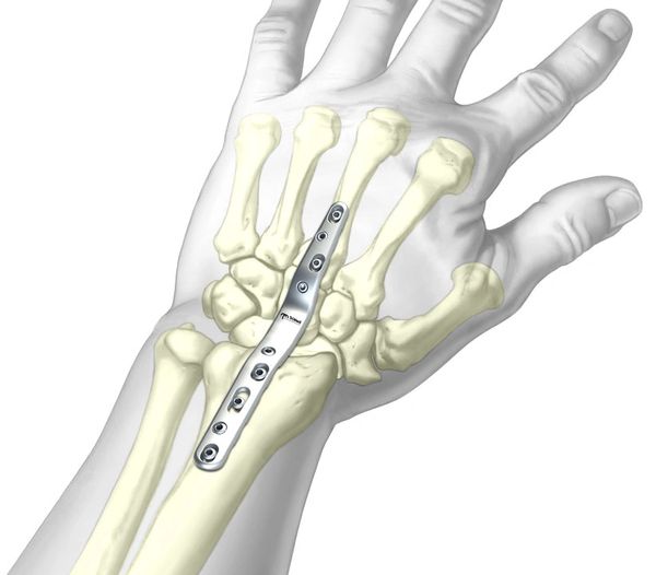 Artrodesis Total Radiocarpiana TriMed