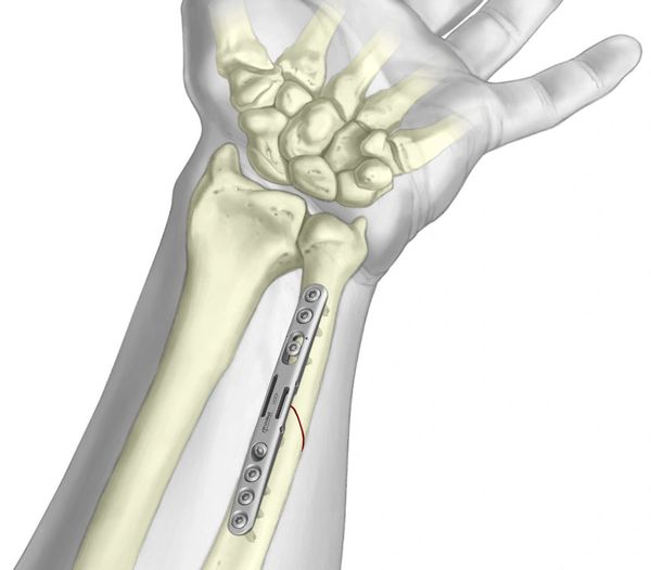 Sistema de Ostetomia Cubital TriMed