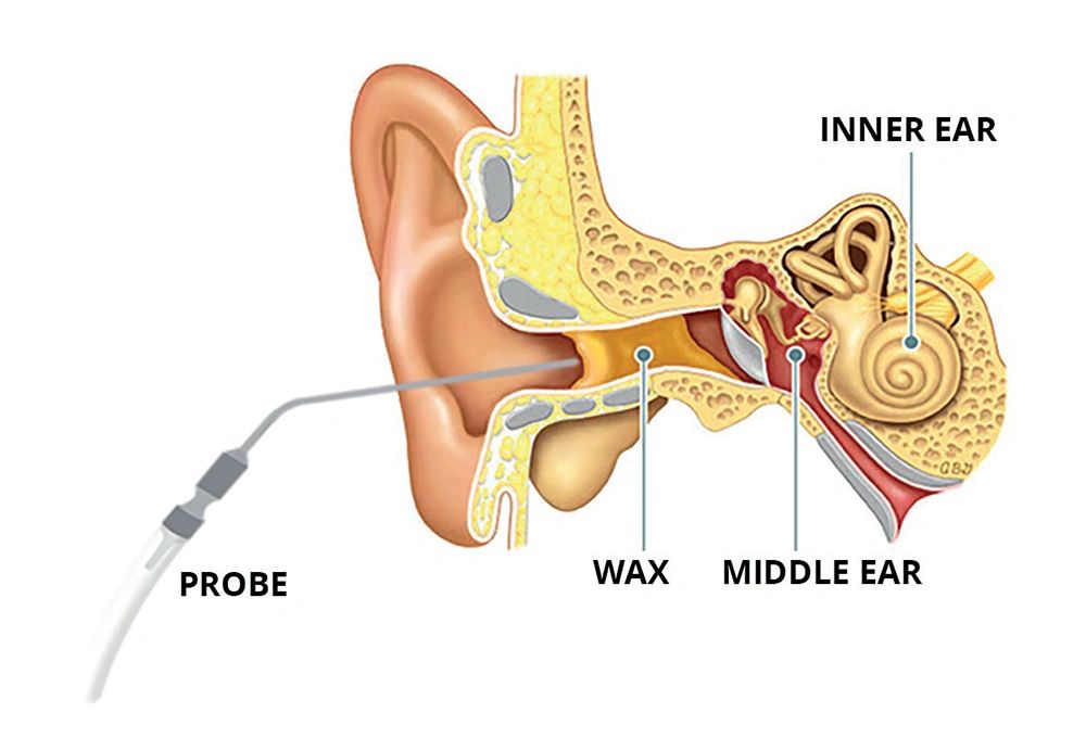 Microsuction Ear Wax removal