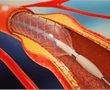 Angioplasty and stenting