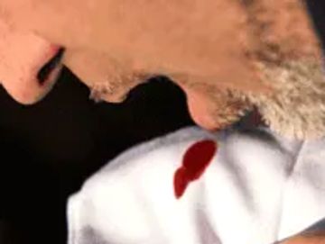 Hemoptysis - coughing out blood - treated with Bronchial artery embolisation