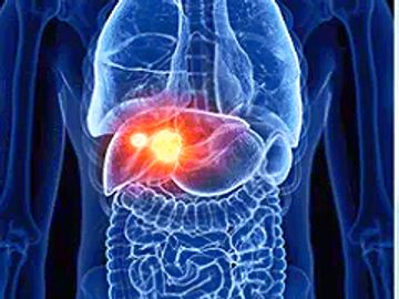 Liver cancer