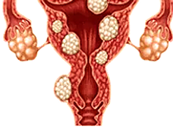 Fibroid - uterine artery embolisation