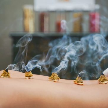 Moxibustion used with alternative natural healing therapies like acupuncture in Durango, CO