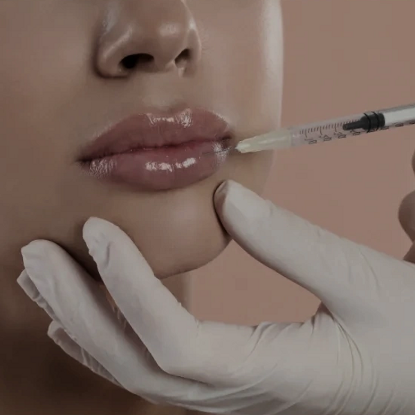 Lip Filler