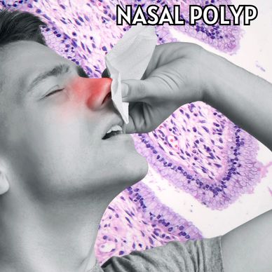 unani treatments for nasal polyp