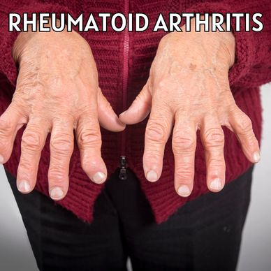 THE Rheumatoid arthritis, or RA, is an autoimmune and inflammatory disease