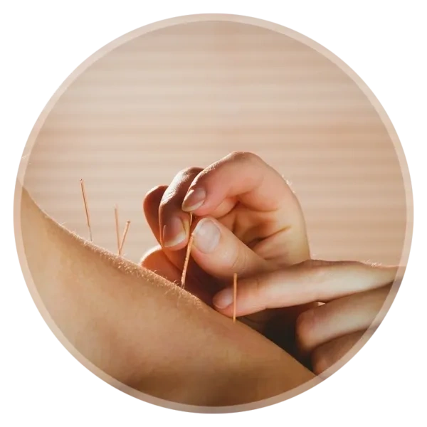 Acupuncture involves the insertion of very thin needles