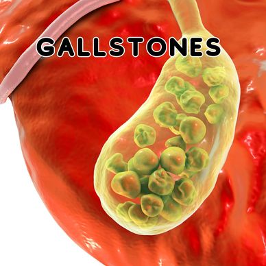 unani treatments for gallstones