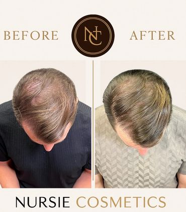 Men's Hair Restoration