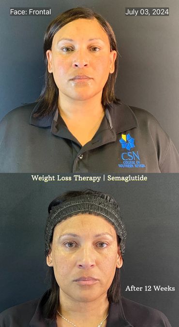 Weight Loss Therapy with Semaglutide