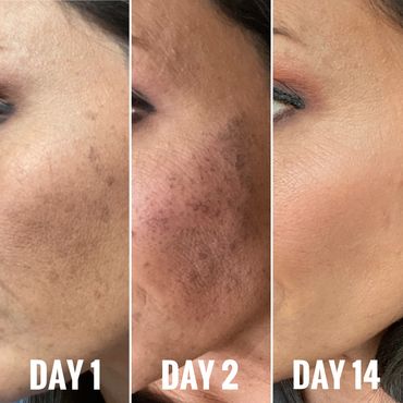 Shape of You IPL Services. A St. Louis area client shares her personal results after only one treat