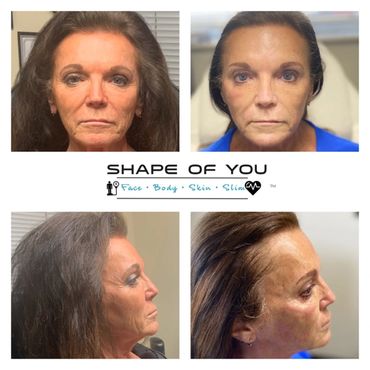 Before and After Ultratherapy Face and the Neck. 9 months between visits. 2 Visits.