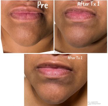 Dermal Remodeling Program- Sarga Exosomes