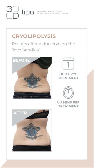 Fat Freezing Cryolipolysis back, thigh, body, arms, mummy tummy, bingo wings abdomen, love handles